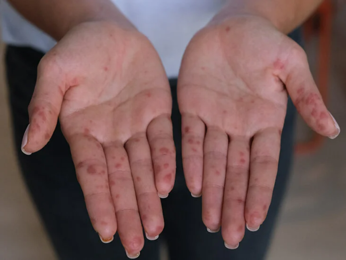 Hand disease