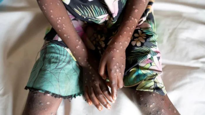 Hundreds of people have been killed by the current mpox outbreak