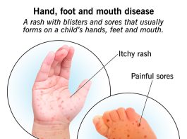 Hand Foot and mouth disease